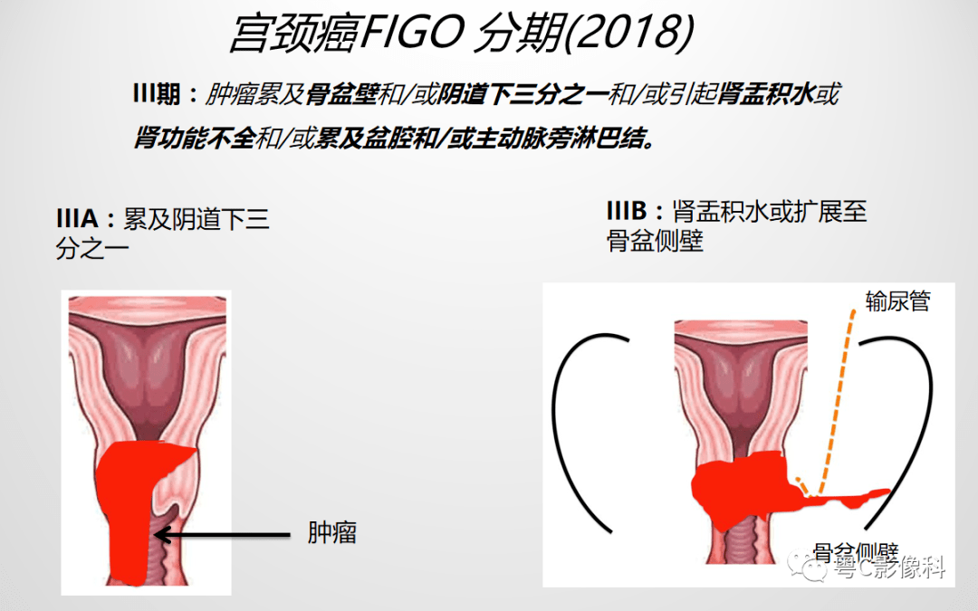 压疮的分期及临床表现最新版