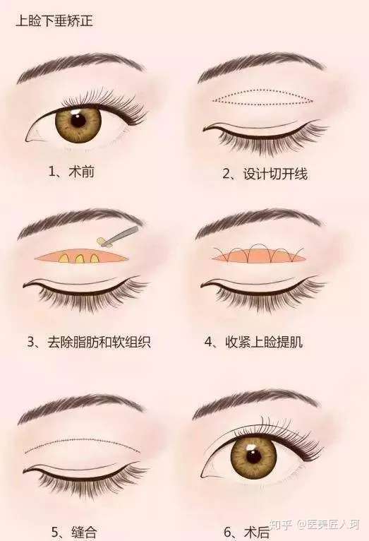 最新的割双眼皮手术，技术革新与个性化美学趋势的融合